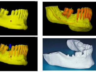 3D печать в стоматологии